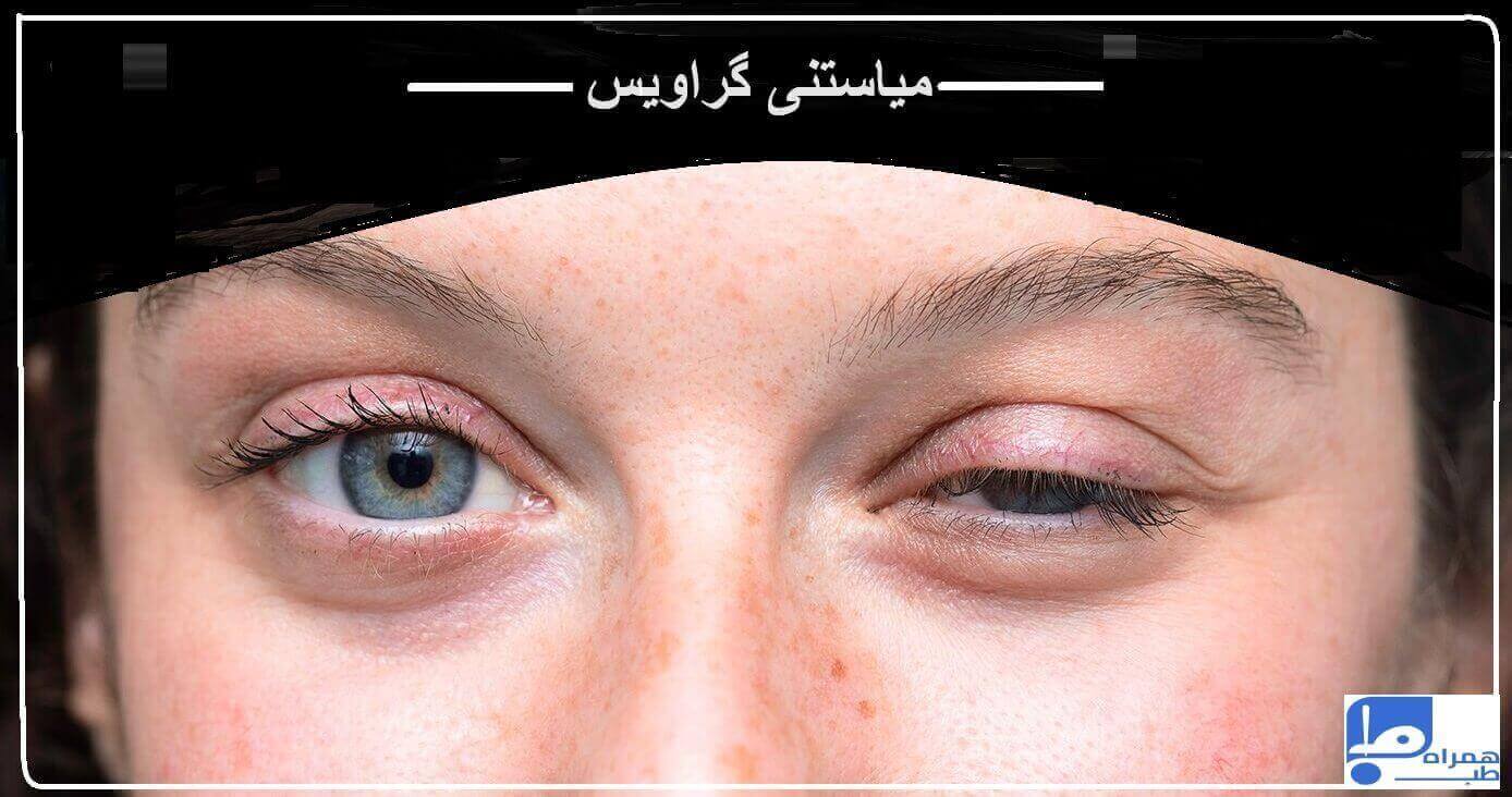 میاستنی گراویس و لکنت زبان در کودکان و بزرگسالان!